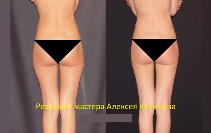 Ручная пластика и Липосакция без последствий Ручная пластика и Липосакция без последствий